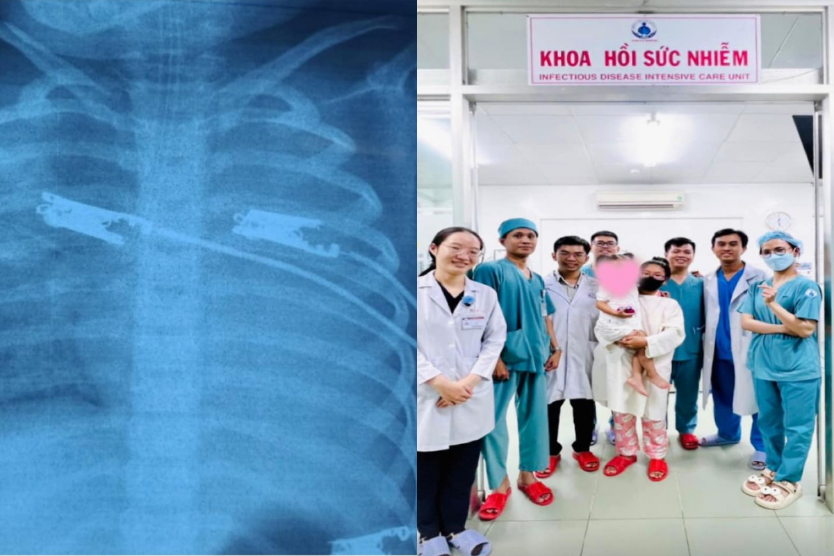mien nam ghi nhan ca sot mo nguy kich dau tien mien nam ghi nhan ca sot mo nguy kich dau tien