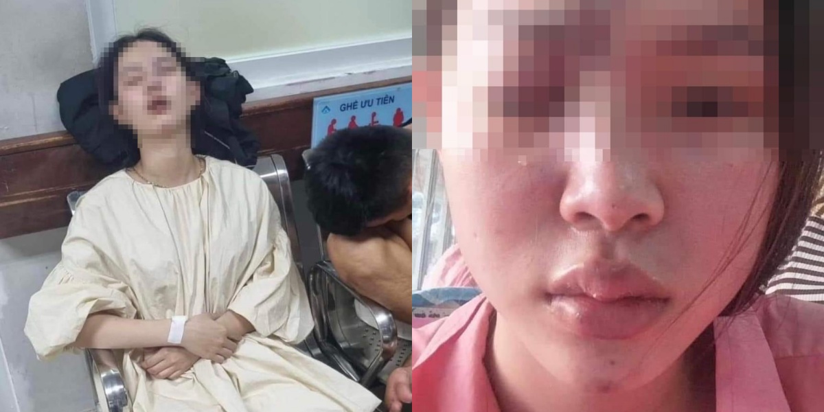 thieu nu mu mot mat liet nua mat sau khi lam mui bac si canh bao nguy co lam dep o co so khong uy tin thieu nu mu mot mat liet nua mat sau khi lam mui bac si canh bao nguy co lam dep o co so khong uy tin