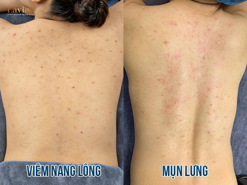 4. Cách điều trị viêm nang lông mụn lưng