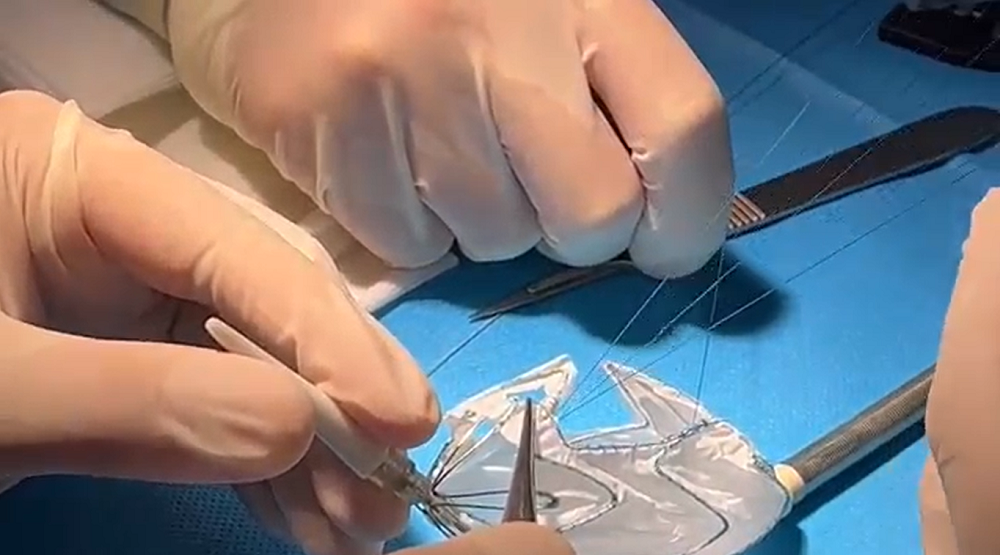 mo cua so truoc khi dat stent graft cho benh nhan