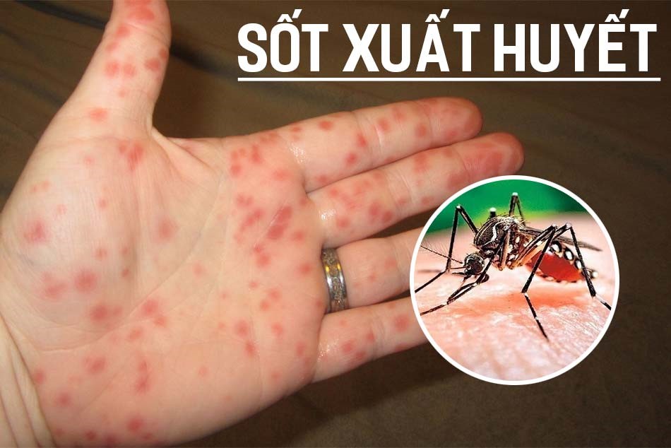 tu mua thuoc dieu tri sot xuat huyet nguoi dan ong suyt mat mang dspl1 tu mua thuoc dieu tri sot xuat huyet nguoi dan ong suyt mat mang dspl1