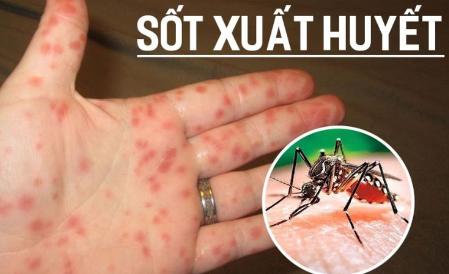 sot xuat huyet sau giai doan nay benh cang chuyen nang khong can than nguy hiem tinh mang dspl sot xuat huyet sau giai doan nay benh cang chuyen nang khong can than nguy hiem tinh mang dspl