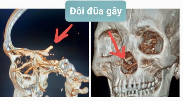 bi ban nhau dung dua dam xuyen mui 5 thang sau moi phat hien dspl bi ban nhau dung dua dam xuyen mui 5 thang sau moi phat hien dspl