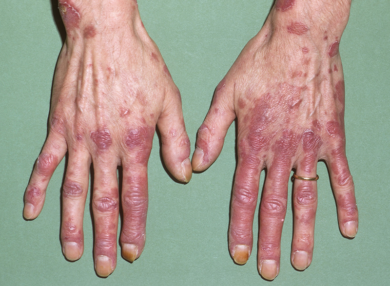 benh lupus ban do co nguy hiem khong bien chung va cach phong benh nhu the nao dspl2 benh lupus ban do co nguy hiem khong bien chung va cach phong benh nhu the nao dspl2