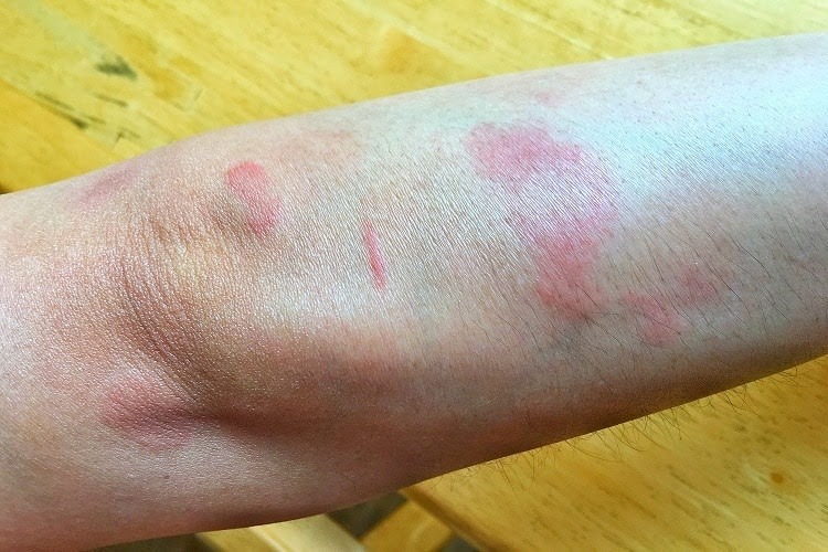 benh lupus ban do co nguy hiem khong bien chung va cach phong benh nhu the nao dspl5 benh lupus ban do co nguy hiem khong bien chung va cach phong benh nhu the nao dspl5