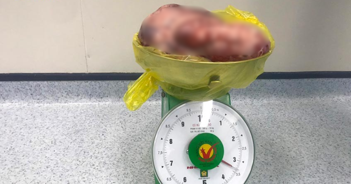 thieu nu 15 tuoi mang khoi u ac tinh nang bang thai du thang 