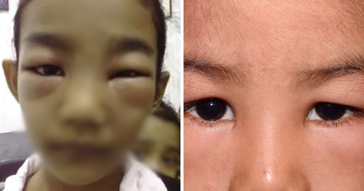 canh bao hoi chung than hu o tre em muc do nguy hiem den tinh mang nhu the nao canh bao hoi chung than hu o tre em muc do nguy hiem den tinh mang nhu the nao