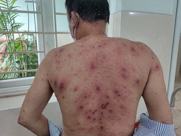 hau qua khon luong khi tu chua benh bang dap la cay thuoc nam khong ro nguon goc dspl41 hau qua khon luong khi tu chua benh bang dap la cay thuoc nam khong ro nguon goc dspl41