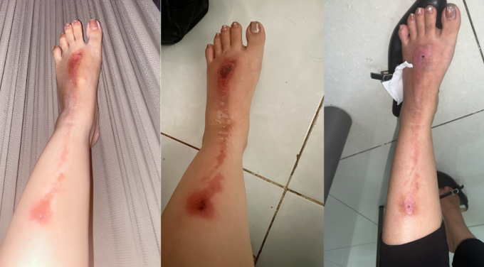 tham gia tiec cuoi nam nguoi phu nu bi bong vi tiet muc ban phao hoa tham gia tiec cuoi nam nguoi phu nu bi bong vi tiet muc ban phao hoa
