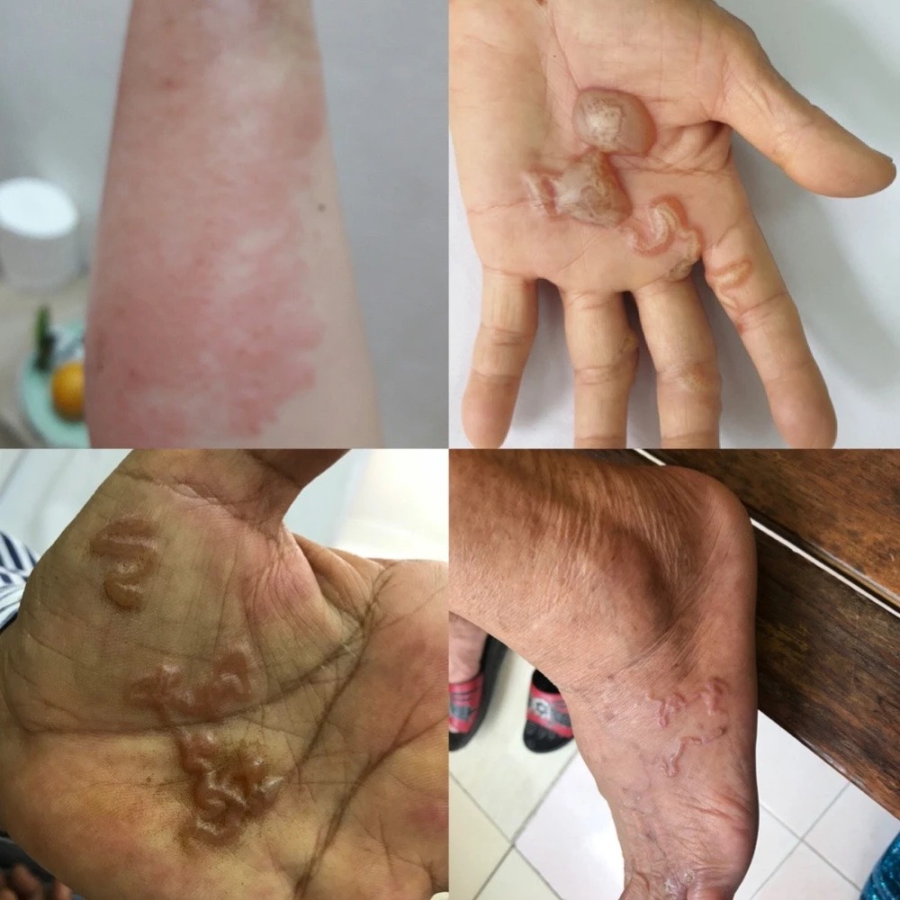 can trong voi nhung dau hieu nghi nhiem ky sinh trung dspl1