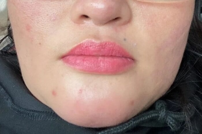 nguoi phu nu bi ap xe cam sau tiem filler lam dep tai mot spa o tp hcm 