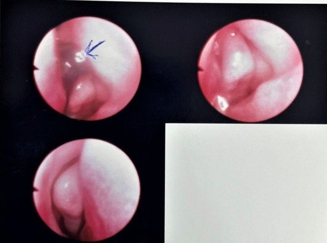 chay mau mui nhieu sau chuyen da ngoai be gai 13 thang tuoi phat hien di vat trong mui chay mau mui nhieu sau chuyen da ngoai be gai 13 thang tuoi phat hien di vat trong mui