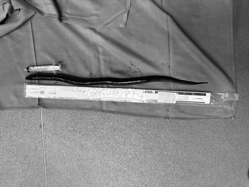 phat hien con luon dai 30cm trong bung nguoi dan ong 34 tuoi phat hien con luon dai 30cm trong bung nguoi dan ong 34 tuoi