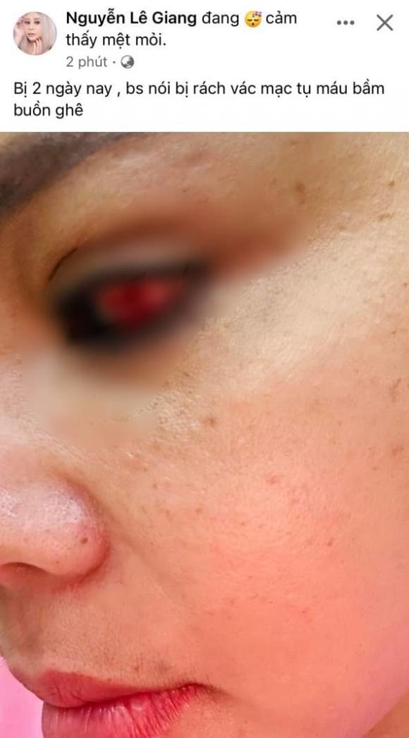 le giang bat ngo thong bao bi rach giac mac tinh trang hien tai gay lo lang dspl le giang bat ngo thong bao bi rach giac mac tinh trang hien tai gay lo lang dspl