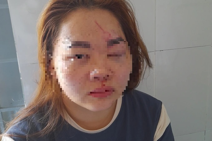co giao mam non bi chong danh bam tim phai nhap vien cap cuu ds co giao mam non bi chong danh bam tim phai nhap vien cap cuu ds