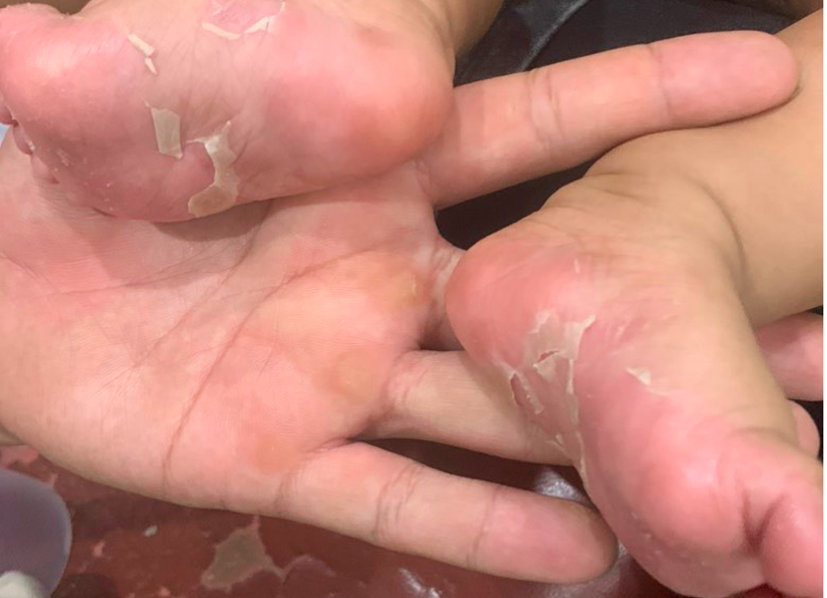 con trai 3 thang tuoi mac giang mai nga ngua khi ca nha ba nguoi bi benh con trai 3 thang tuoi mac giang mai nga ngua khi ca nha ba nguoi bi benh