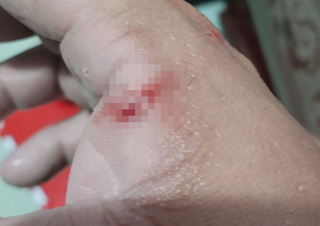 cho can nhung khong chiu chich ngua nguoi dan ong bieu hien nghi benh dai can vo chay mau cho can nhung khong chiu chich ngua nguoi dan ong bieu hien nghi benh dai can vo chay mau