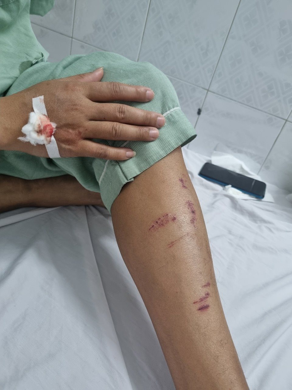 mau thuan ca nhan mot luat su bi tong nga vang xuong duong phai nhap vien