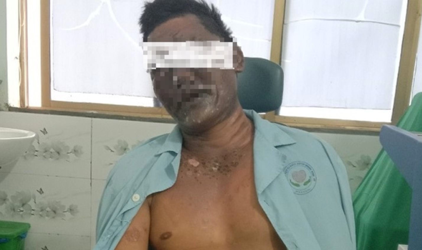 nguoi dan ong bi bong bien dang mat vi no binh gas mini khi an lau nguoi dan ong bi bong bien dang mat vi no binh gas mini khi an lau