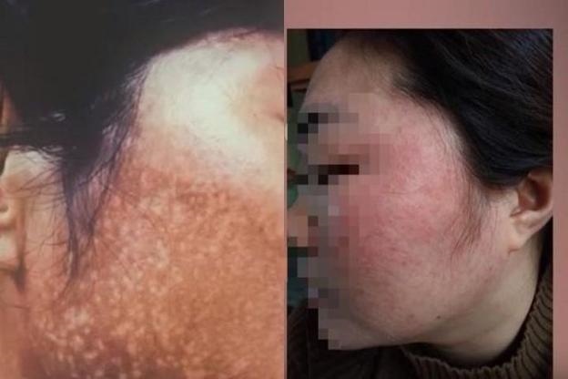 cuc quan ly duoc canh bao mau kem tri nam co ham luong thuy ngan vuot muc cuc quan ly duoc canh bao mau kem tri nam co ham luong thuy ngan vuot muc