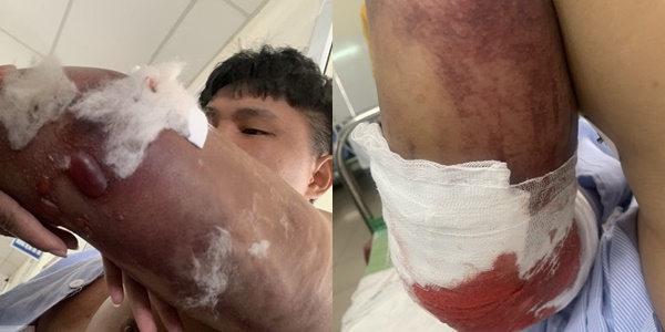 vu shipper bi danh gay 2 tay o quang ngai doi vo chong van chua xin loi nan nhan3