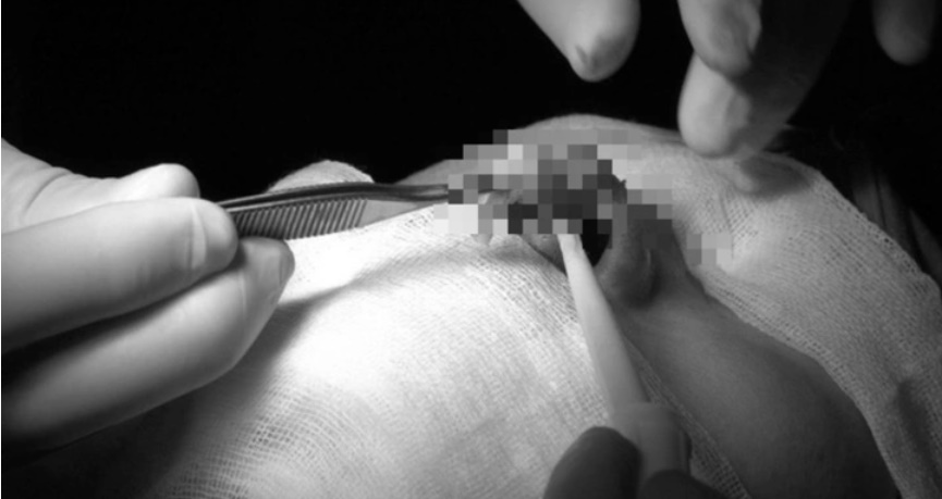 An ninh - Hình sự - Vụ tiêm filler giá rẻ bị tai biến, 'lột' sạch tài sản: Công an truy tìm 'Thủy thẩm mỹ'