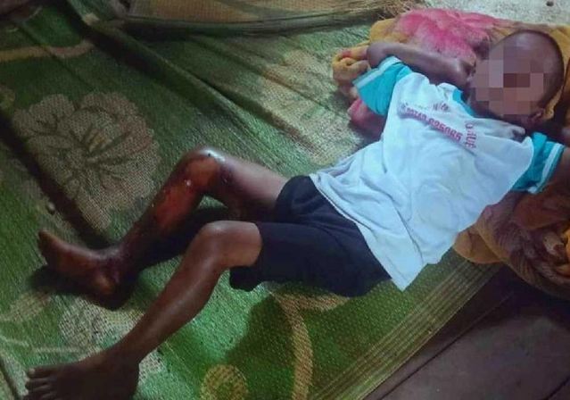 be tra 8 tuoi bi dot bong 2 chan dspl