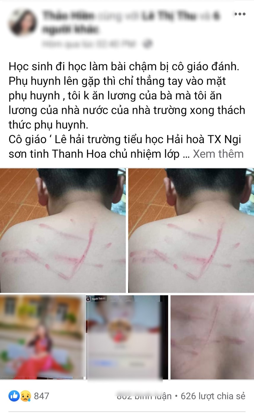 Xác minh làm rõ vụ học sinh lớp 4 bị cô giáo đánh bầm tím vì không làm bài  tập