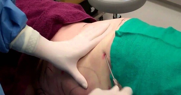 vu nguoi phu nu 31 tuoi tu vong sau khi hut mo bung co so tham my khong co bang cap chung chi