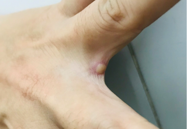 tp hcm phat hien ca mac dau mua khi thu hai