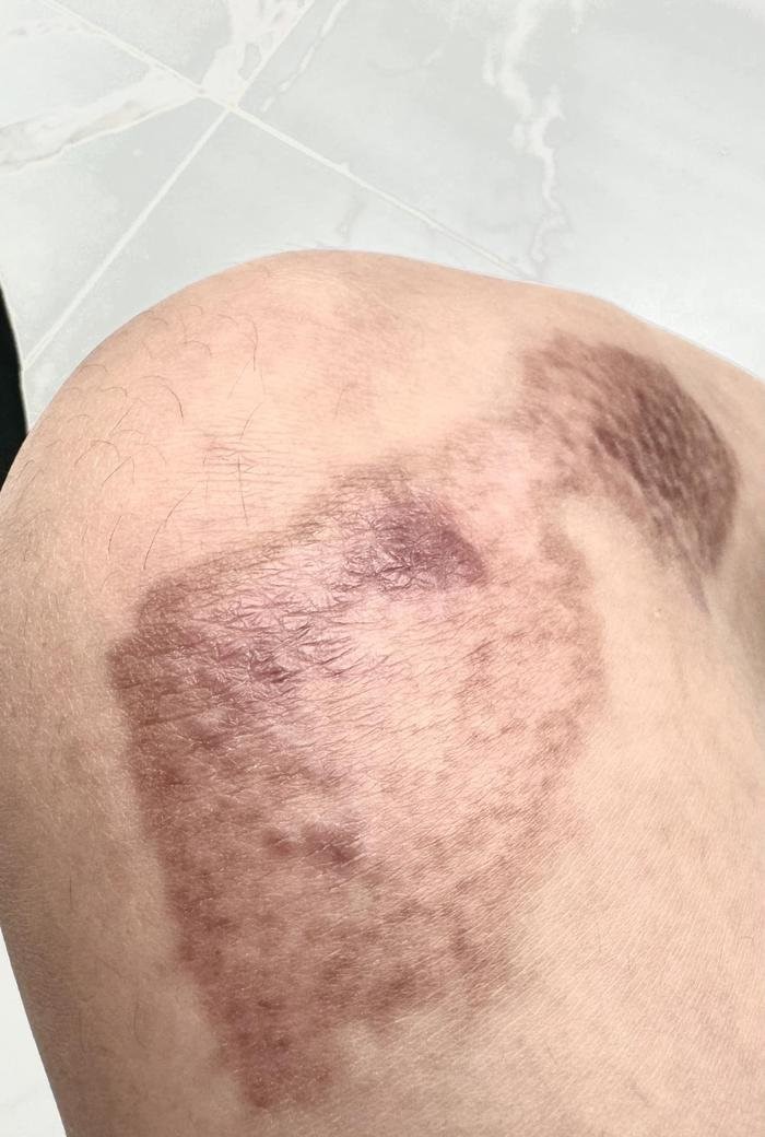 ngoc trinh ngam ngui chia se tinh trang nhung vet thuong sau 4 thang gap tai nan lai xe mo to4 ngoc trinh ngam ngui chia se tinh trang nhung vet thuong sau 4 thang gap tai nan lai xe mo to4