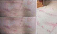Tin tức mới nhất vụ học sinh lớp 4 bị cô giáo dùng roi tre đánh tím lưng