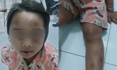Cha về quê, con gái 6 tuổi bị vợ chồng cô ruột đánh đập tàn bạo