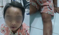 Tin tức thời sự mới nóng nhất hôm nay 18/7: Bé gái 6 tuổi bị vợ chồng cô ruột đánh đập tàn bạo