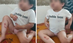 Hà Tĩnh: Bé 4 tuổi nhập viện với nhiều vết thương đáng ngờ, nghi bị bạo hành