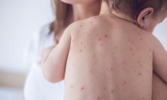 Lo ngại dịch chồng dịch, Thủ tướng yêu cầu phòng chống bệnh đậu mùa khỉ sớm hơn một bước, cao hơn một mức