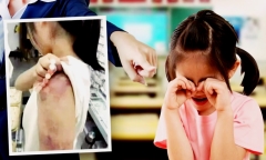 Học sinh bị cô giáo đánh bầm tay vì không nghe lời, thái độ của phụ huynh khiến nhiều người bất ngờ