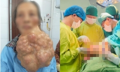 Mang khối u khổng lồ hơn 10 năm, người phụ nữ gặp biến chứng khó thở đau tức