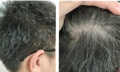 Nhiều người trẻ tóc bạc trắng từ sớm, bác sĩ chỉ ra nguyên nhân