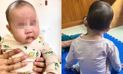 Bé 4 tháng tuổi đã vẹo cổ vì hành vi nhiều bố mẹ mắc phải