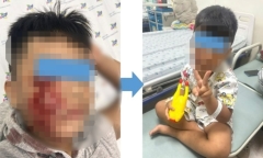 Đang chơi trong sân nhà, bé trai bị chó dữ tấn công, khâu 20 mũi