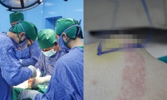 Cụ ông 86 tuổi bị ung thư vú, bệnh lý hiếm gặp chỉ 1/1000 độ ác tính ở nam giới