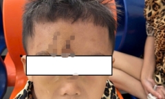 Bé trai 5 tuổi bị chó dữ nhà hàng xóm cắn trọng thương khi đang chơi trước nhà