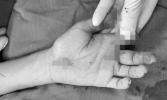 Nghịch pháo tự chế, nam sinh 14 tuổi ở Thái Bình bị thương nặng