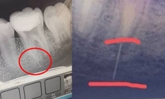 Bé gái 13 tuổi gặp sự cố hi hữu khi điều trị tủy răng