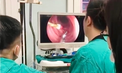 Đi diệt tủy răng, bé trai 8 tuổi bị kim rơi vào bụng