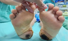 Tự điều trị đau cột sống bằng cách dân gian, nữ bệnh nhân suýt liệt vĩnh viễn
