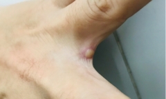 TP. HCM phát hiện ca mắc đậu mùa khỉ thứ hai