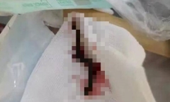 Cô gái vật vã vì đau tai, bác sĩ kiểm tra liền phát hiện thứ rợn người bên trong
