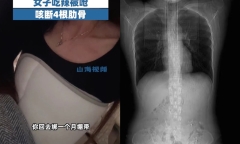Ăn đồ cay bị ho, cô gái gãy luôn 4 xương sườn
